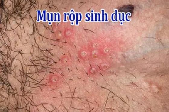 mun-rop-sinh-duc-la-benh-gi.jpg